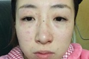 猫过敏（了解猫过敏的表现及如何应对）